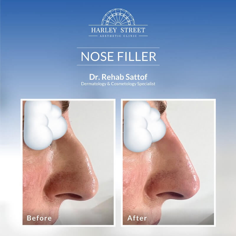 Nose Filler Dr Rehab Abu Dhabi