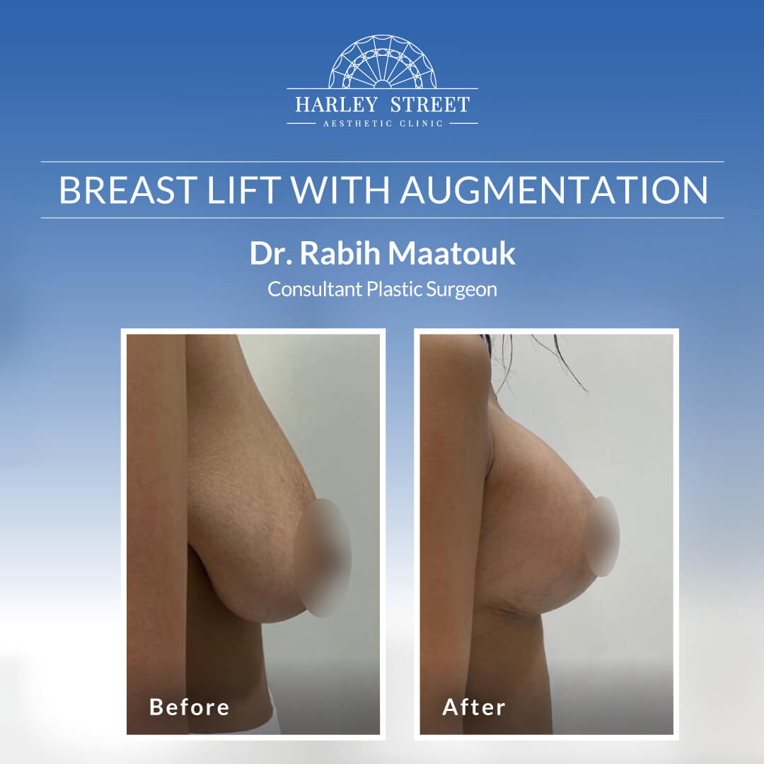 Breast Lift Dr. Rabih