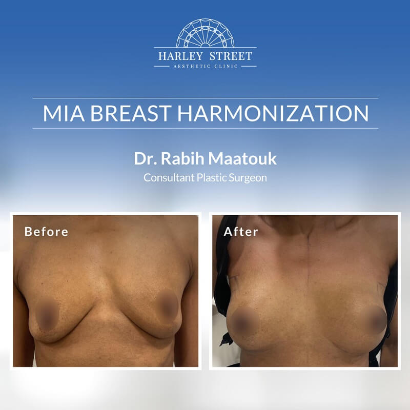 Dr.-Rabih MIA-Breast Surgery After