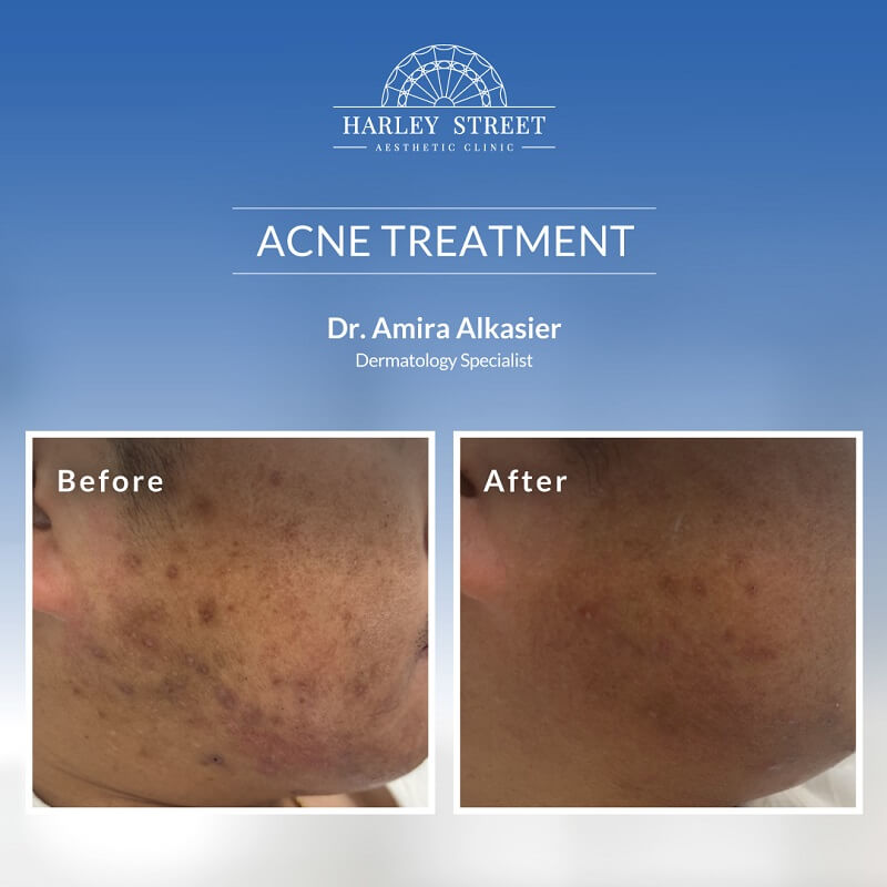 ACNE Treatment Dr. Amira