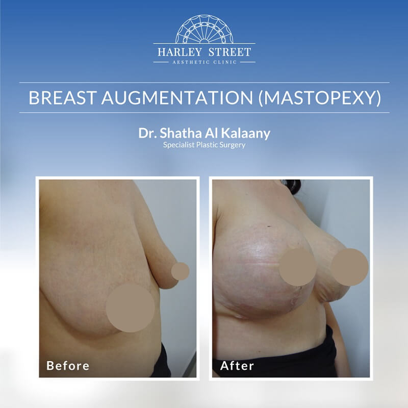 Breast Augumentation Dr. Shatha