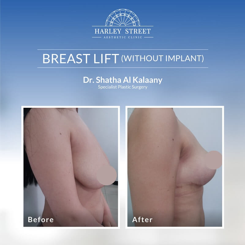 Breast Lift Dr. Shatha