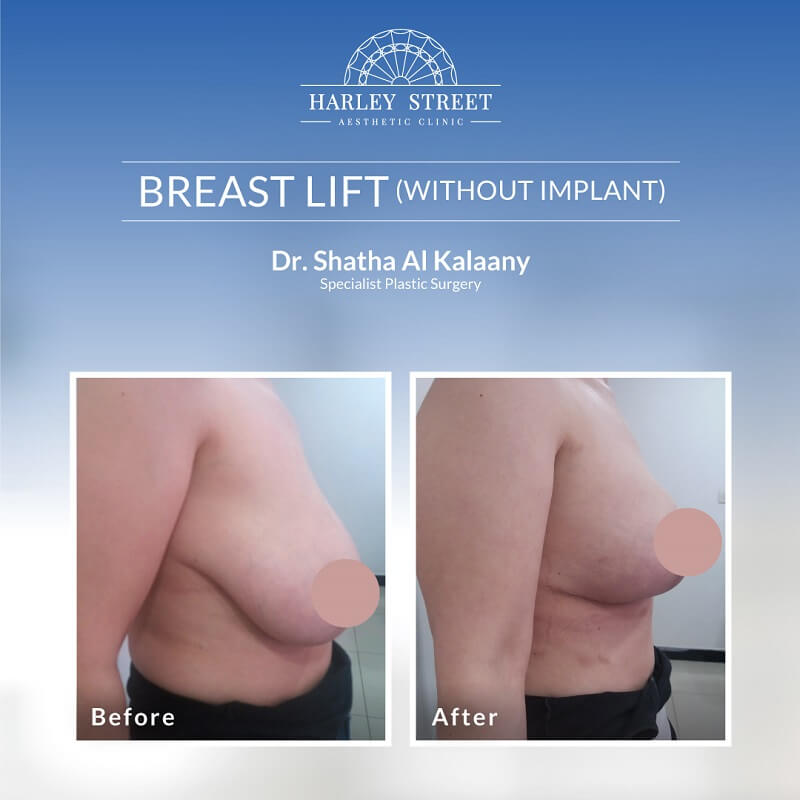 Breast Lift without Implant Dr. Shatha Before-After