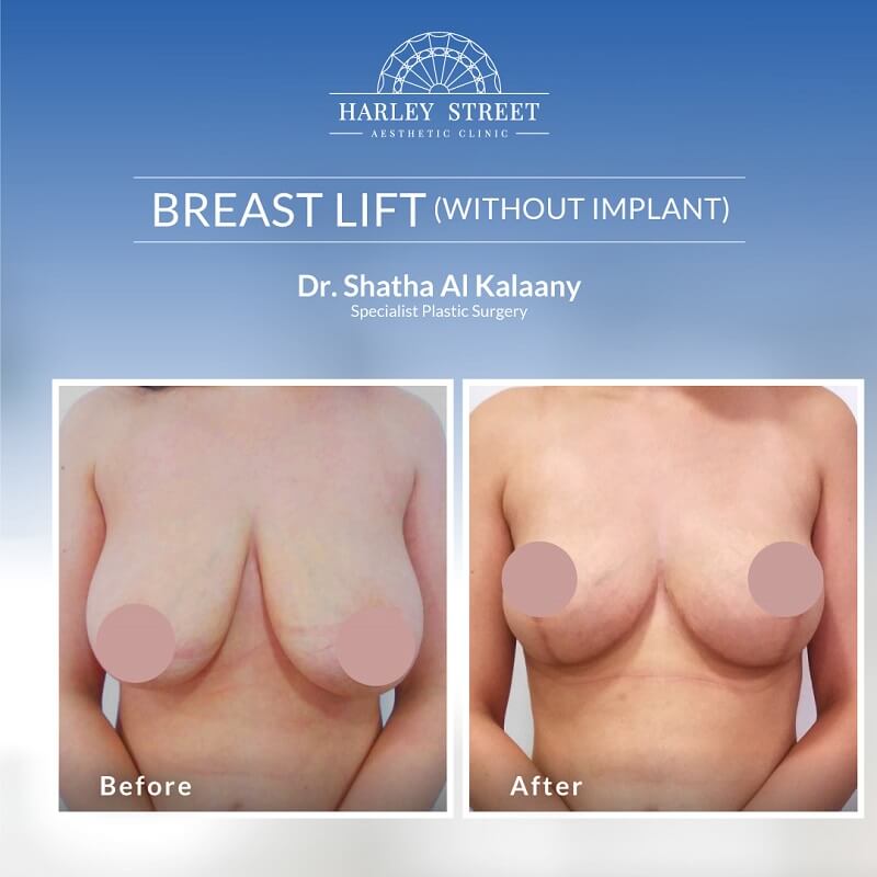 Breast Lift without Implant Dr. Shatha