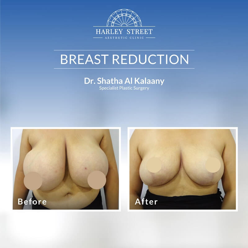 Breast Reduction Dr. Shatha