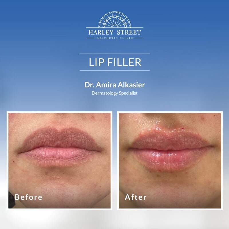 Dr. Amira Lip Filler Abu Dhabi