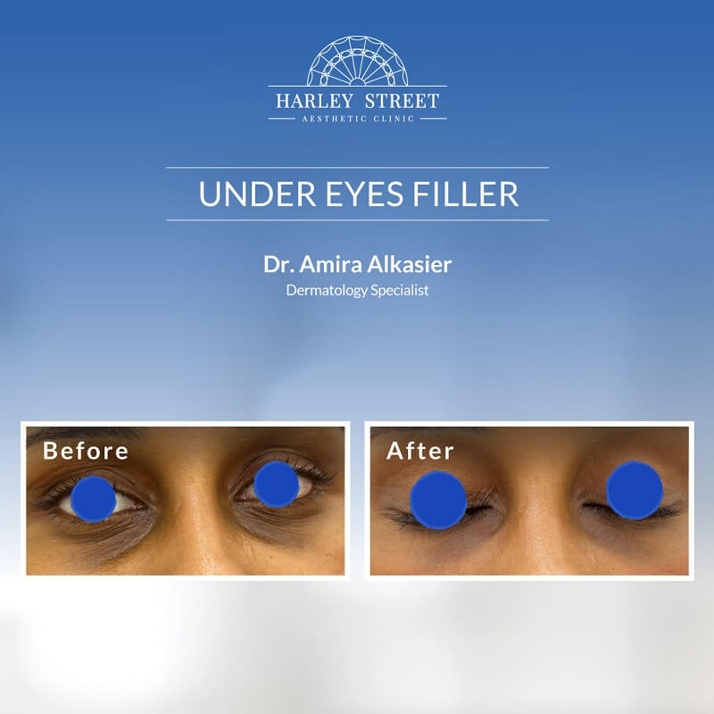 Under Eye Filler by Dr. Amira